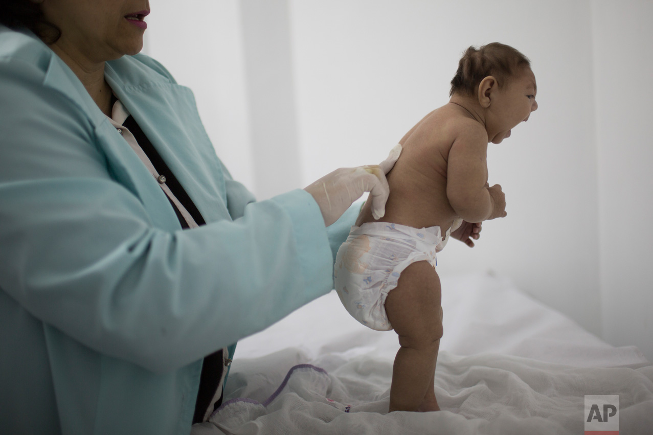  Lara, who is less then three months old and was born with microcephaly, is examined by a neurologist at the Pedro I hospital in Campina Grande, Paraiba state, Brazil, Friday, Feb. 12, 2016. Alarm in recent months over the Zika virus, which many rese
