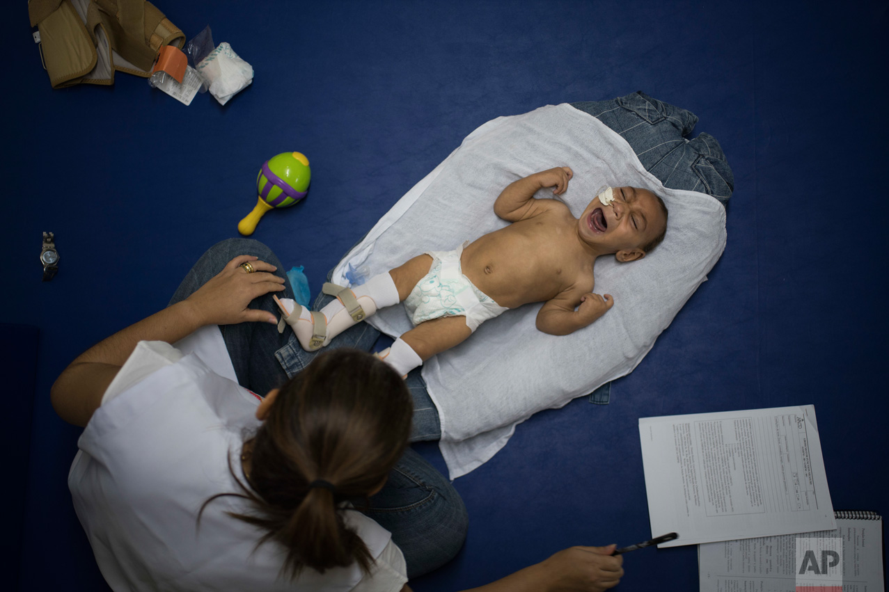  In this Sept. 30, 2016 photo, 1-year-old Jose Wesley Campos, who was born with microcephaly, cries during his physical therapy session at the AACD rehabilitation center in Recife, Brazil. Jose is like a newborn. He is slow to follow objects with his
