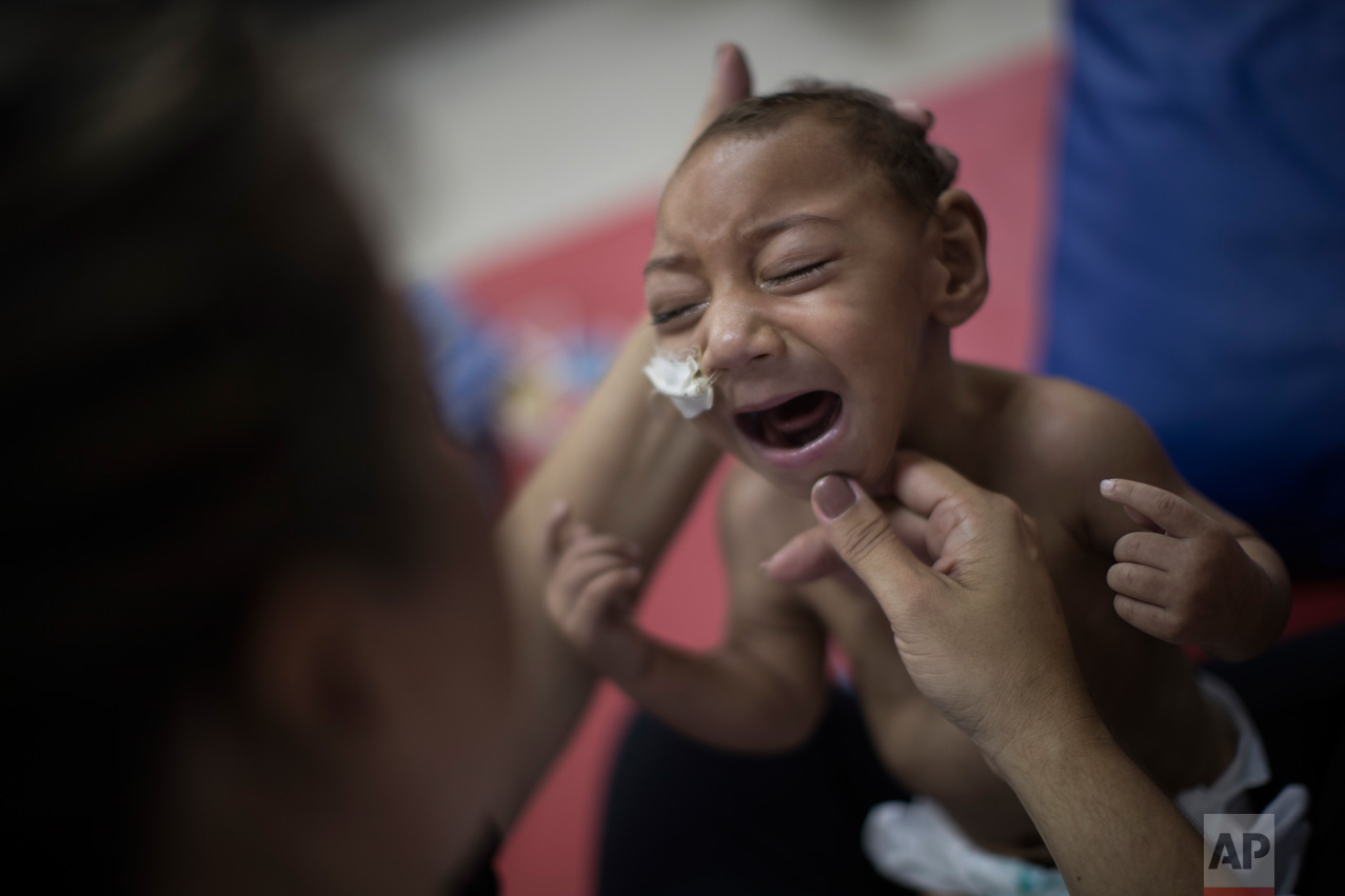  In this Sept. 28, 2016 photo, one-year-old Jose Wesley Campos, who was born with microcephaly, cries during a physical therapy session at the AACD rehabilitation center in Recife, Brazil. Breathing problems make his cries sound like gargling, and hi
