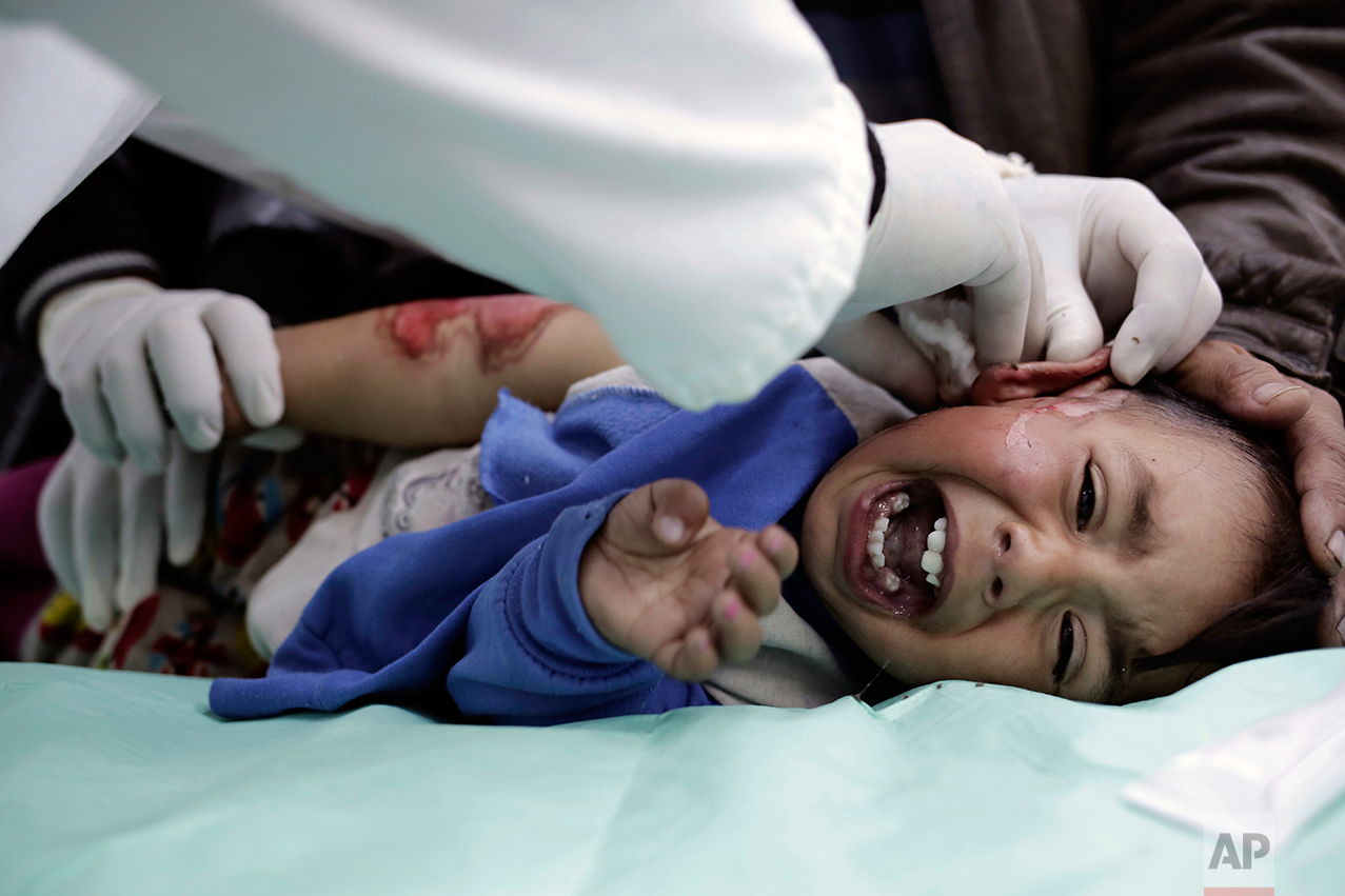  A child with severe burns, from scalding water, cries out in pain as a medic cleans his wounds at a hospital in the Zahra neighborhood of Mosul, Iraq, Tuesday, Feb. 14, 2017. Doctors in the small clinic in eastern Mosul say that since the operation 