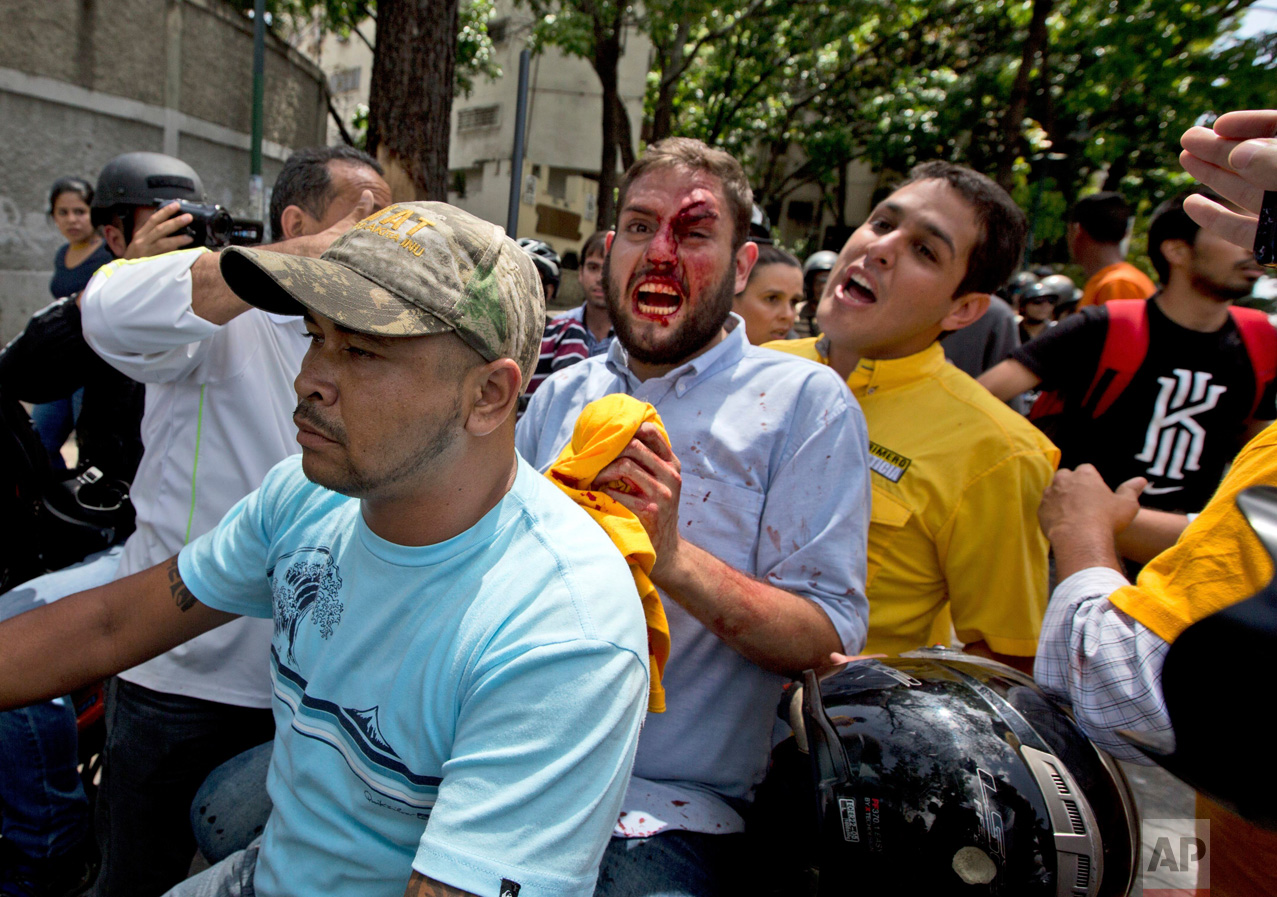Opposition lawmaker Juan Requesens, center, is escorted by his colleague Jose Manuel Olivares, right, after being injured by alleged pro government supporters as they protest outside of the Ombudsman's offices in Caracas, Venezuela, Monday, April 3, 2017. A group of opposition lawmakers was attacked by suspected followers of the Government during a demonstration in the center of the capital that left at least one injured Congressman. (AP Photo/Fernando Llano)