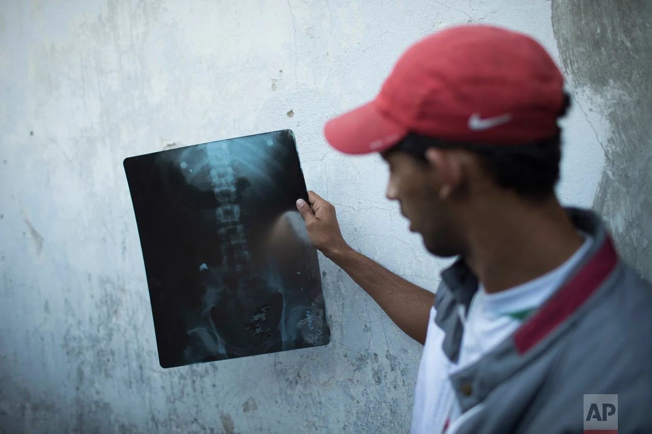 In this June 10, 2017 photo, Alexandre Henrique da Cruz Correia holds an X-ray showing a bullet lodged in his left hip in the City of God slum of Rio de Janeiro, Brazil, after he was recently shot while walking home from his grandmother's. (AP Photo/Leo Correa)