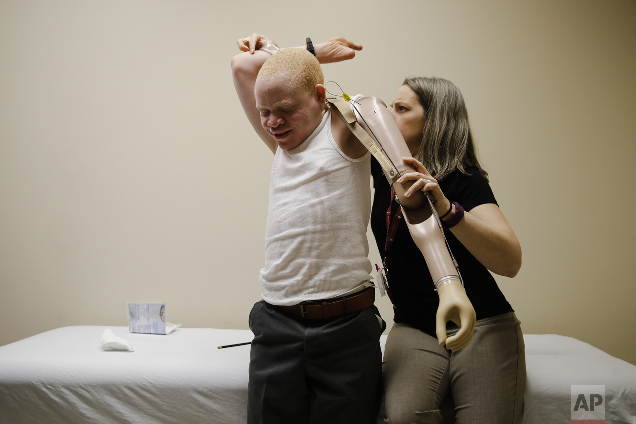 Albino Children Prosthetics