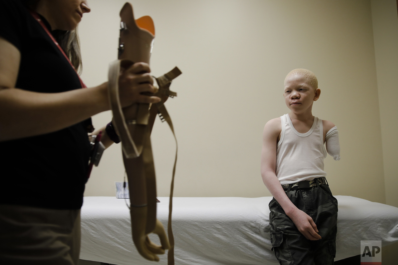 Albino Children Prosthetics