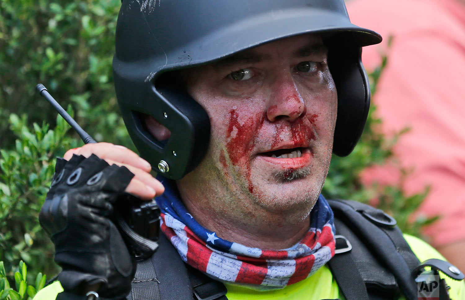  A white nationalist demonstrator, bloodied after a clash with a counter demonstrator,  talks on the radio receiver at the entrance to Lee Park in Charlottesville, Va., Saturday, Aug. 12, 2017. Gov. Terry McAuliffe declared a state of emergency and p