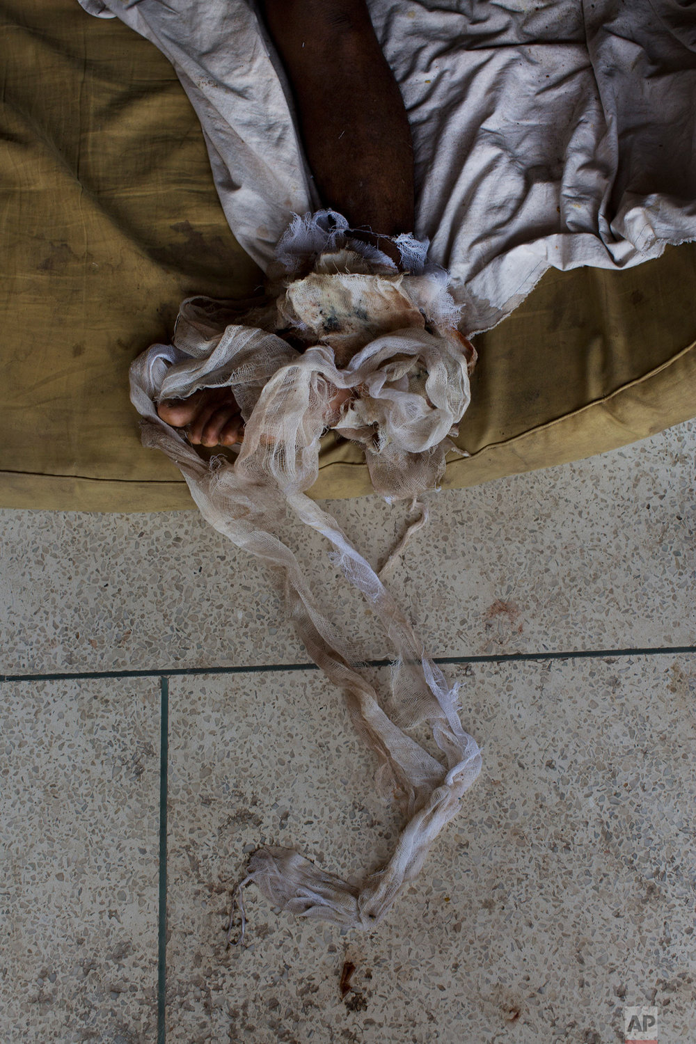  EDS NOTE GRAPHIC CONTENT - Rohingya men Abdul Karim lies on the floor at Sadar Hospital in Cox's Bazar, Bangladesh, Sunday, Sept. 10, 2017. Karim sustained severely bullet injuries on his left foot and chest when Myanmar monks and soldiers attacked 