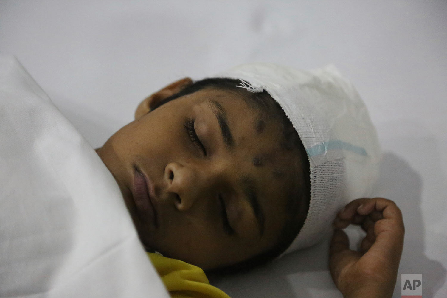  A Pakistani child injured by mortars fired from Indian forces is treated at a hospital in Sialkot, Pakistan, Friday, Sept. 22, 2017. (AP Photo/K.M. Chaudary) 