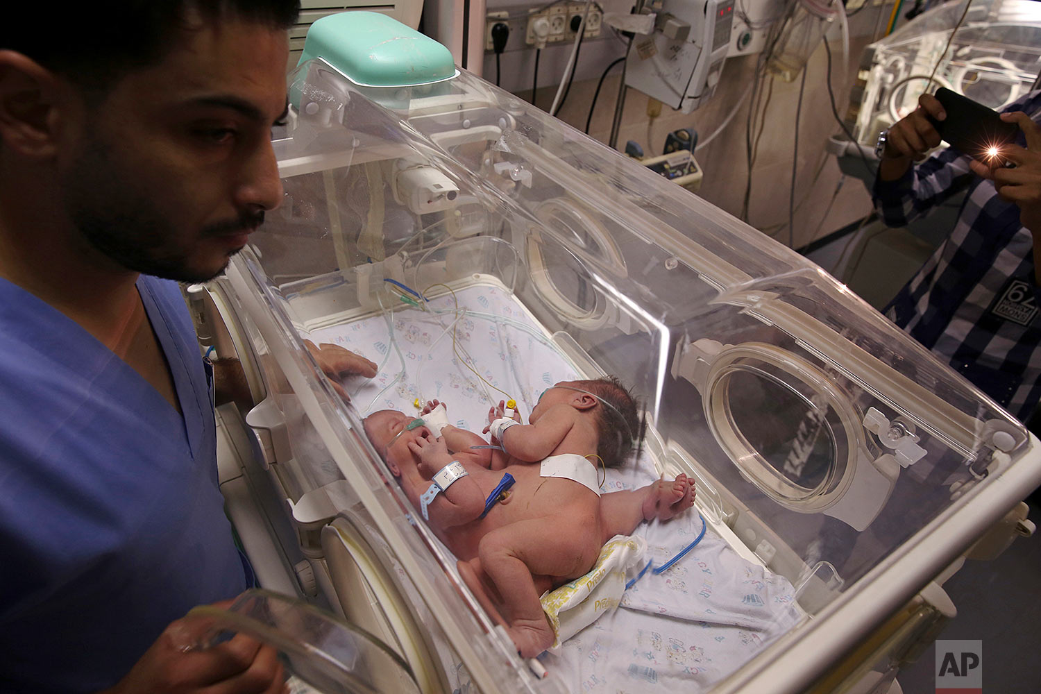 Palestinians Conjoined Twins