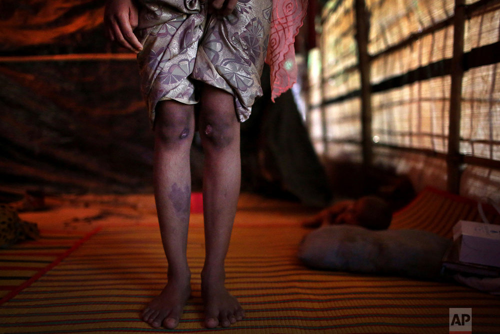  In this Sunday, Nov. 19, 2017, photo, R, 13, shows off the scars on her knees and right shin from injuries obtained when members of Myanmar's armed forces dragged her out of her house before gang raping her, during an interview with The Associated P