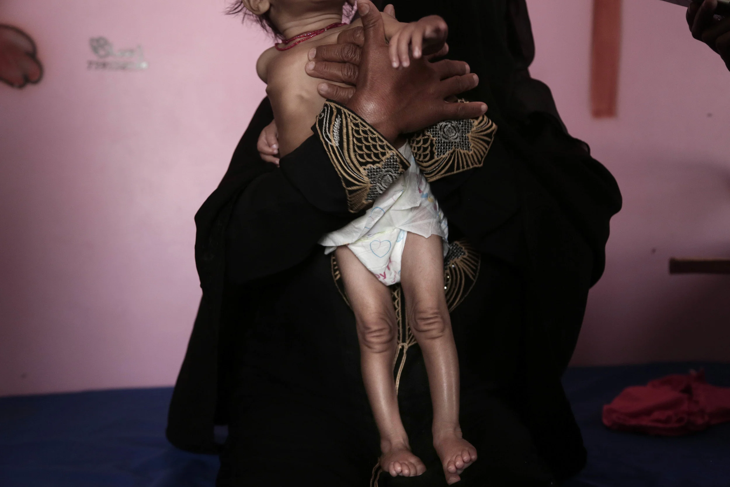 Yemen Starvation