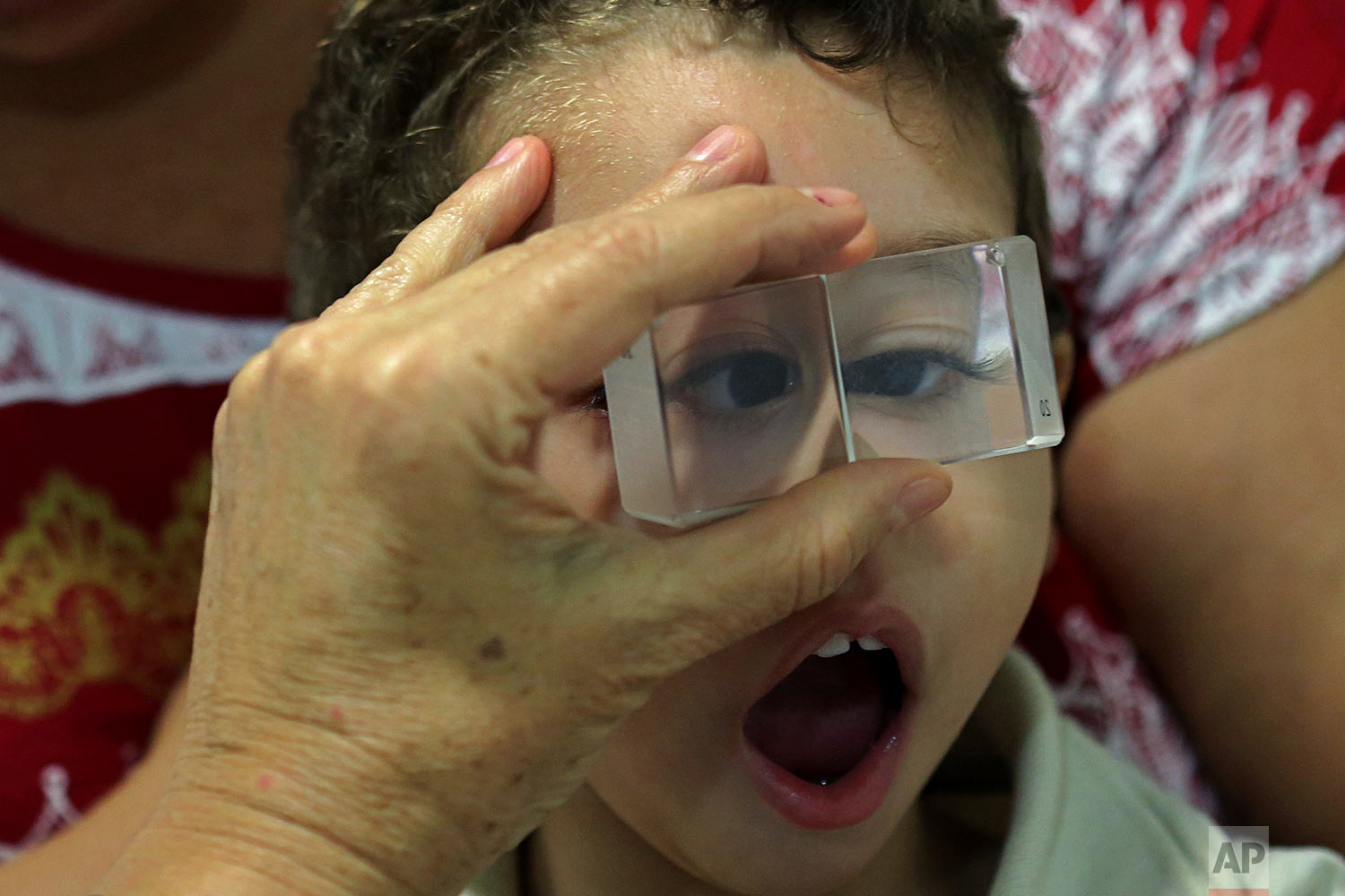  In this May 3, 2018 photo published in June, 2-year-old Luiz Mauricio, who was born with the Zika-caused microcephaly birth defect, takes an ophthalmology exam at the Altino Ventura Institute in Recife, Brazil. (AP Photo/Eraldo Peres) 