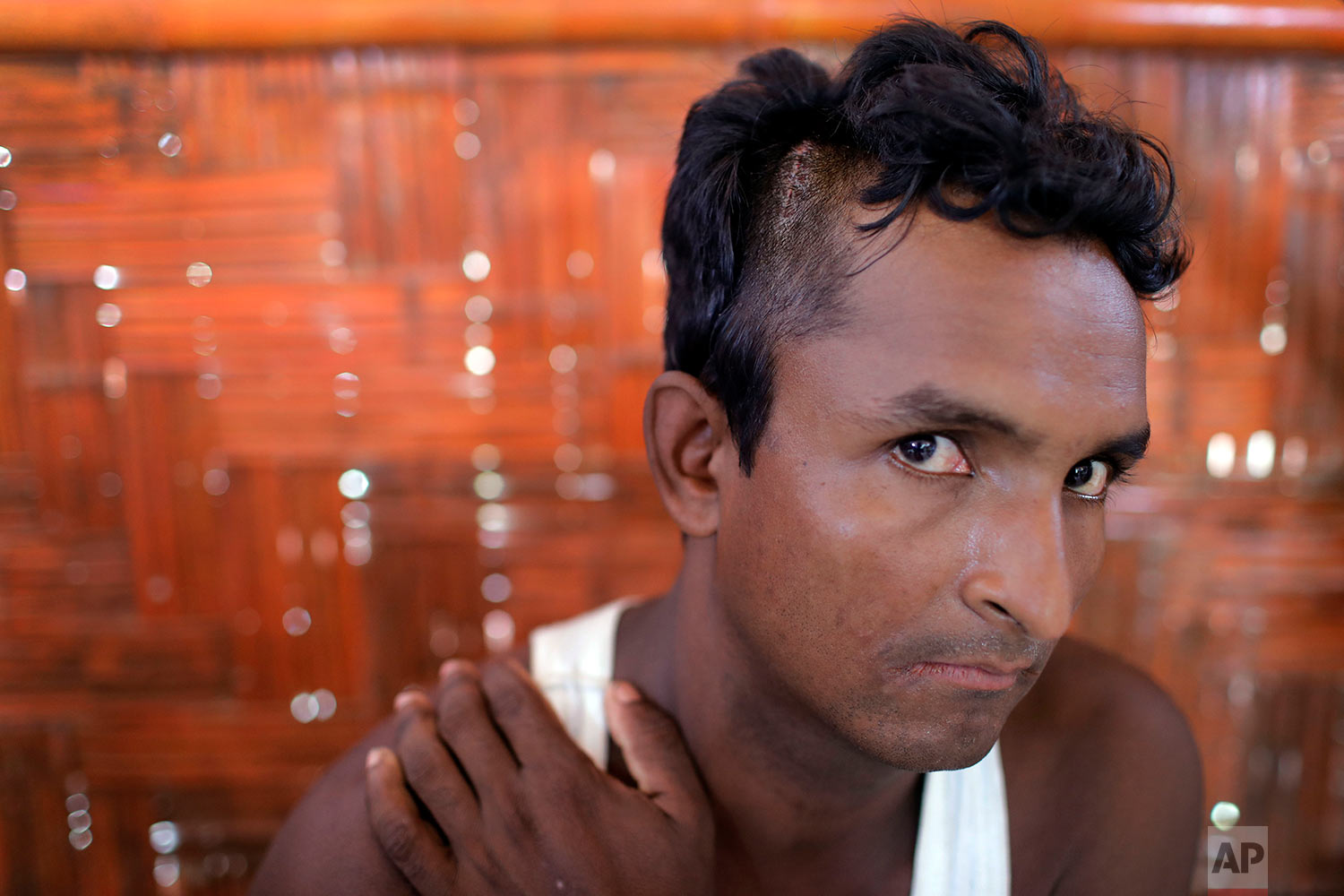  In this Wednesday, June 27, 2018, photo, Mohamed Alom poses for a portrait as he rests at a school which has been turned into a temporary shelter in Chakmarkul refugee camp, Bangladesh. The 27-year-old was asleep in his shelter last month when a tor