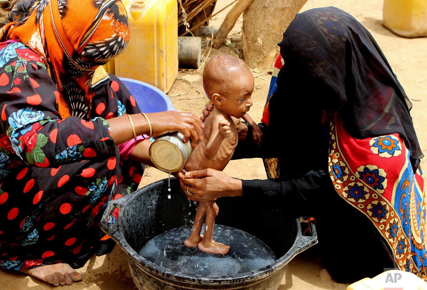 A severely malnourished infant is bathed in a bucket, Aug. 25, 2018 Aslam, Hajjah, Yemen. (AP Photo/Hammadi Issa)