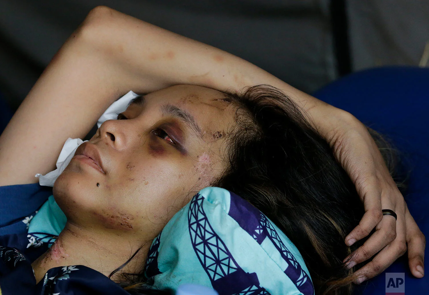 Anisa Cornelia rests as she lies inside a medical tent after being injured in a massive earthquake and tsunami in Palu, Central Sulawesi, Indonesia, Oct. 4, 2018. (AP Photo/Aaron Favila)