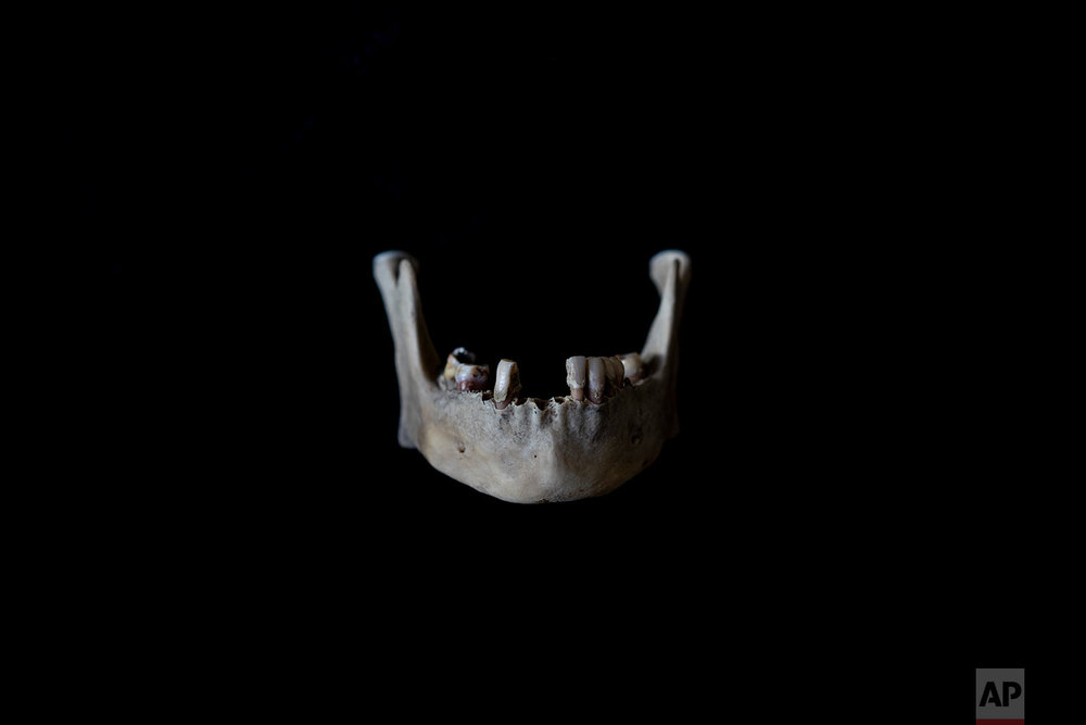  In this Monday Oct. 1, 2018 photo, the jaw of a black unidentified adult male is seen. The remains were found in August 2018 in a field in Johannesburg and brought to a mortuary for identification purposes. Once a demographic profile is estimated it