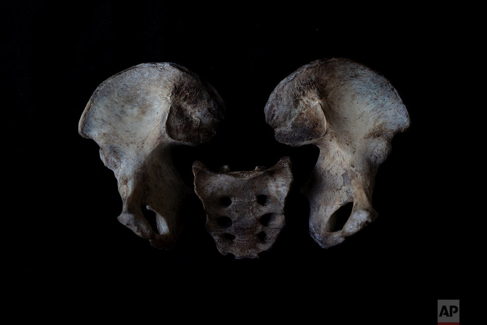  In this Monday Oct. 1, 2018 photo, the pelvis  of a black unidentified adult male is seen. The remains were found in August 2018 in a field in Johannesburg and brought to a mortuary for identification purposes. Once a demographic profile is estimate