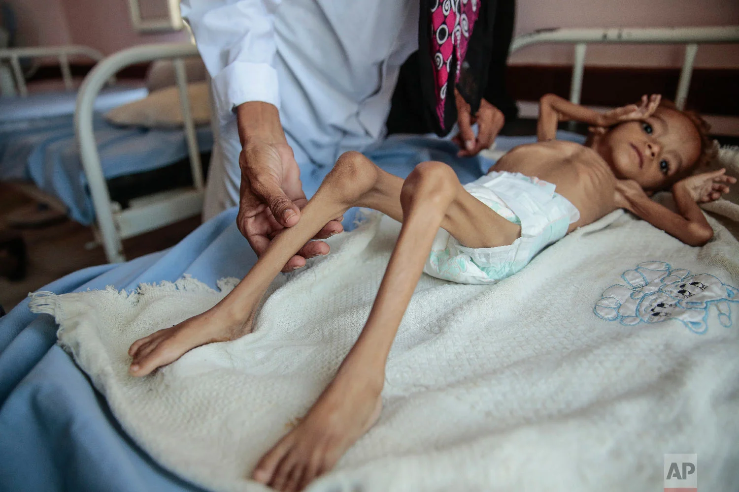 A severely malnourished boy rests on a hospital bed at the Aslam Health Center, Hajjah, Yemen. (AP Photo/Hani Mohammed)