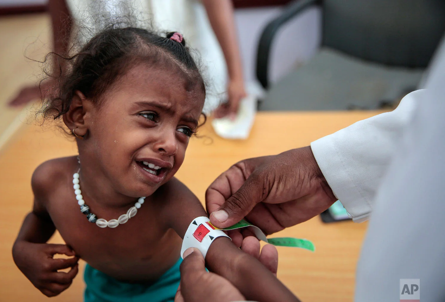A doctor measures the arm of malnourished girl at the Aslam Health Center, Hajjah, Yemen. (AP Photo/Hani Mohammed)