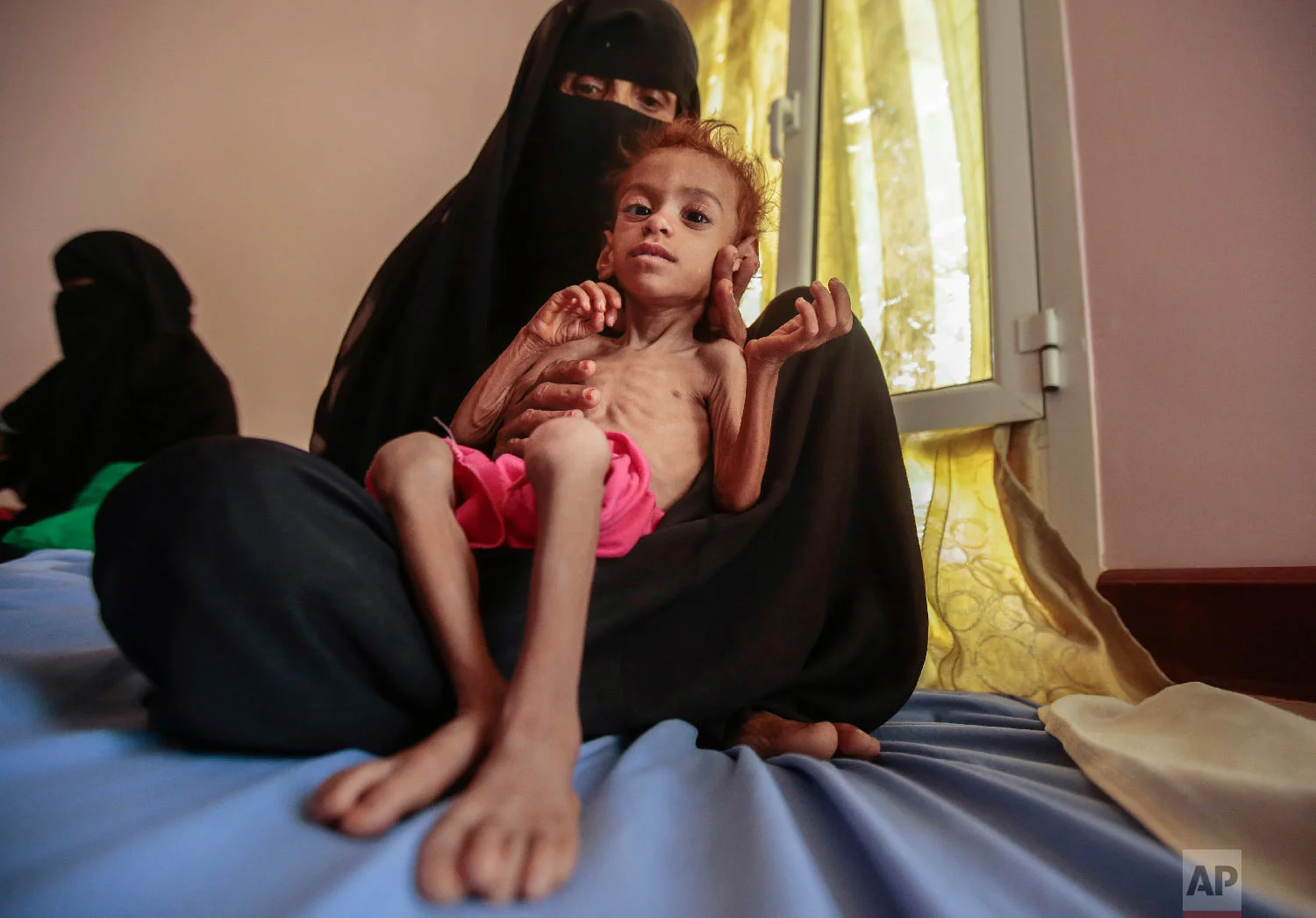 A woman holds a malnourished boy at the Aslam Health Center, in Hajjah, Yemen. (AP Photo/Hani Mohammed)