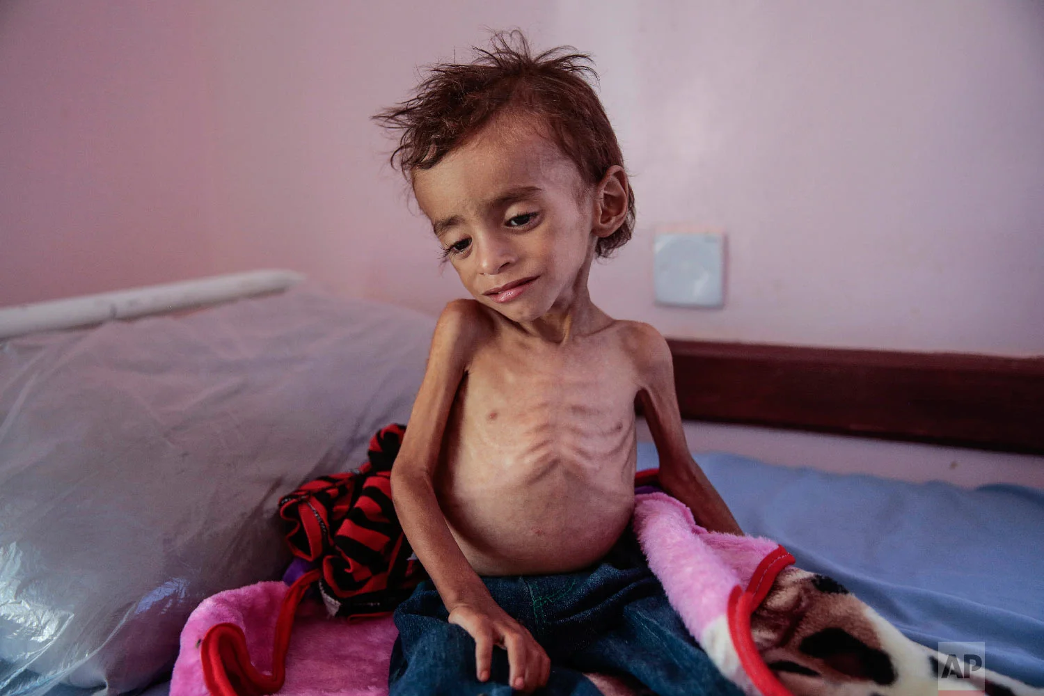 A malnourished boy sits on a hospital bed at the Aslam Health Center, Hajjah, Yemen. (AP Photo/Hani Mohammed)