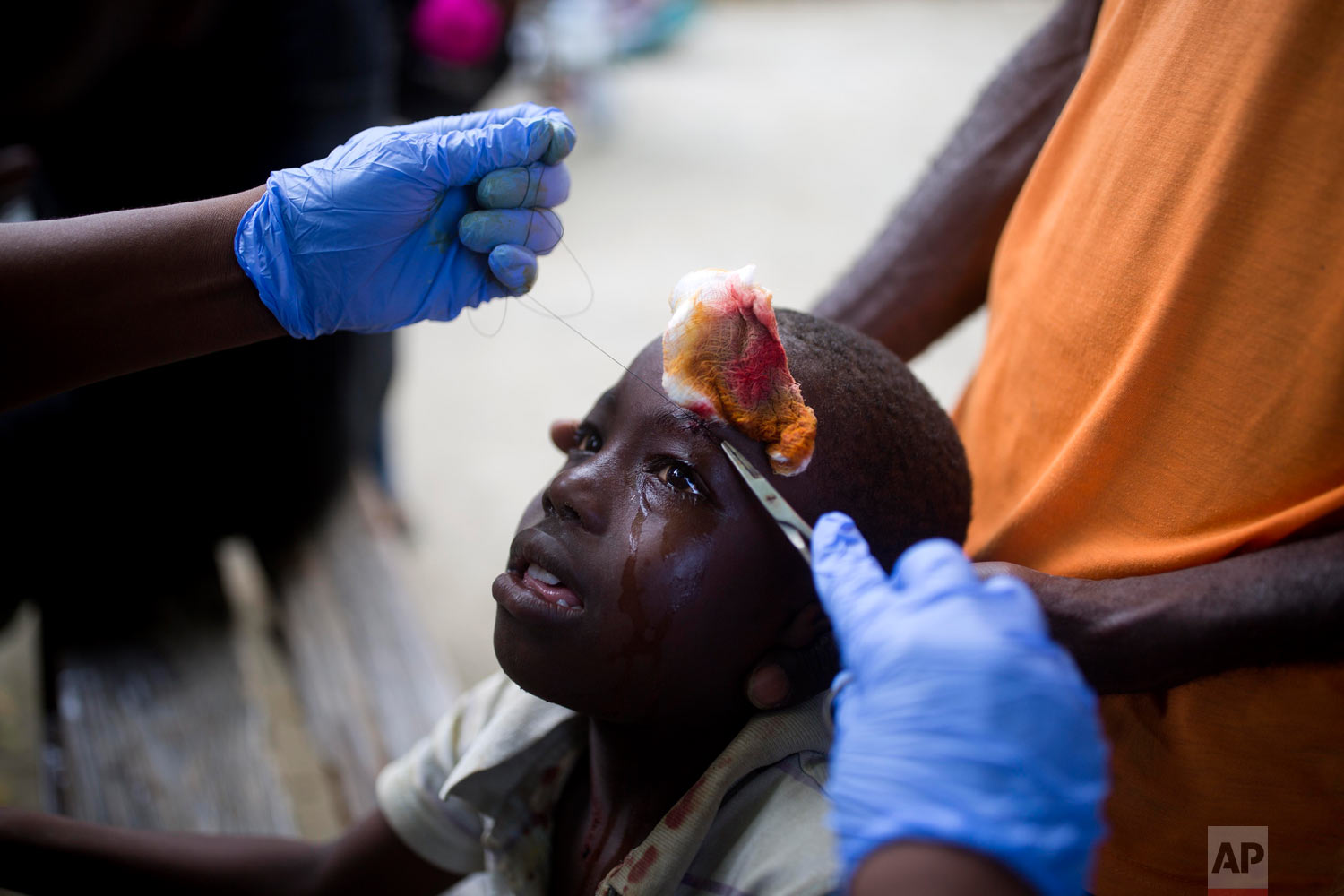  A boy who was injured by an aftershock receives treatment at the general hospital in Port-de-Paix, Haiti, Oct. 7, 2018. A magnitude 5.2 aftershock struck Haiti on Sunday, even as survivors of the previous day's temblor were sifting through the rubbl