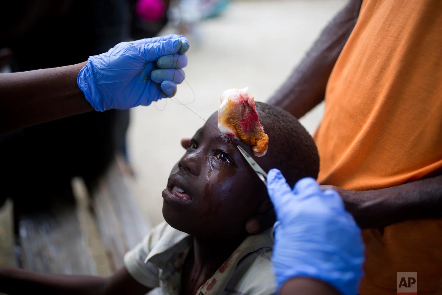 A boy who was injured by an aftershock receives treatment at the general hospital in Port-de-Paix, Haiti, Oct. 7, 2018. A magnitude 5.2 aftershock struck Haiti on Sunday, even as survivors of the previous day's temblor were sifting through the rubble of their cinderblock homes. The death toll stood at 12, with fears it could rise. (AP Photo/Dieu Nalio Chery)