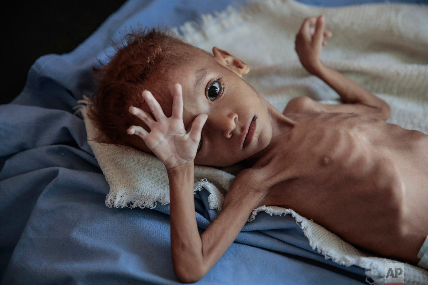  A severely malnourished boy rests on a hospital bed at the Aslam Health Center, in Hajjah, Yemen, on Oct. 1, 2018. Malnutrition, cholera, and other epidemic diseases have ravaged through displaced and impoverished communities in Yemen, threatening t