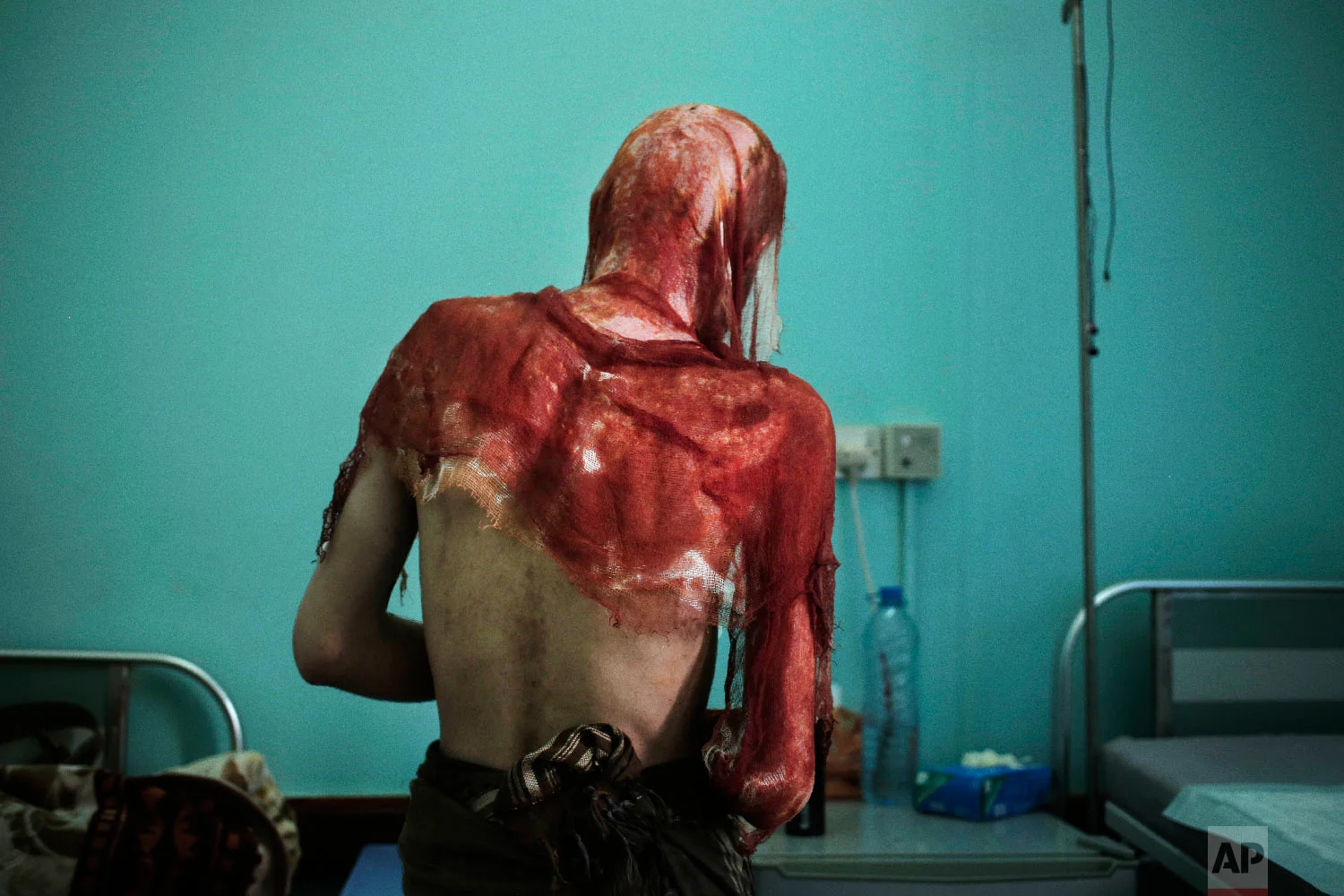 Monir al-Sharqi walks to his bed after nurses changed the dressings on his burns, at the Marib General Hospital in Yemen in this July 25, 2018 photo. Al-Sharqi, a lab technician, disappeared for a year, until he was dumped in a stream, half-naked, emaciated and bearing horrific marks of torture. He had burns from acid over his head, back and shoulders, so severe that his jacket stuck to his melted skin. Some members of his family believe he was detained and tortured by Yemen’s Houthi rebels because of his past political activism. (AP Photo/Nariman El-Mofty)