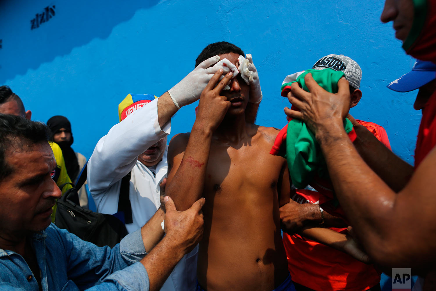  A demonstrator is given first aid after he was injured in the face during clashes with the Venezuelan Bolivarian National Guard in Urena, Venezuela, near the border with Colombia, Saturday, Feb. 23, 2019. (AP Photo/Rodrigo Abd) 