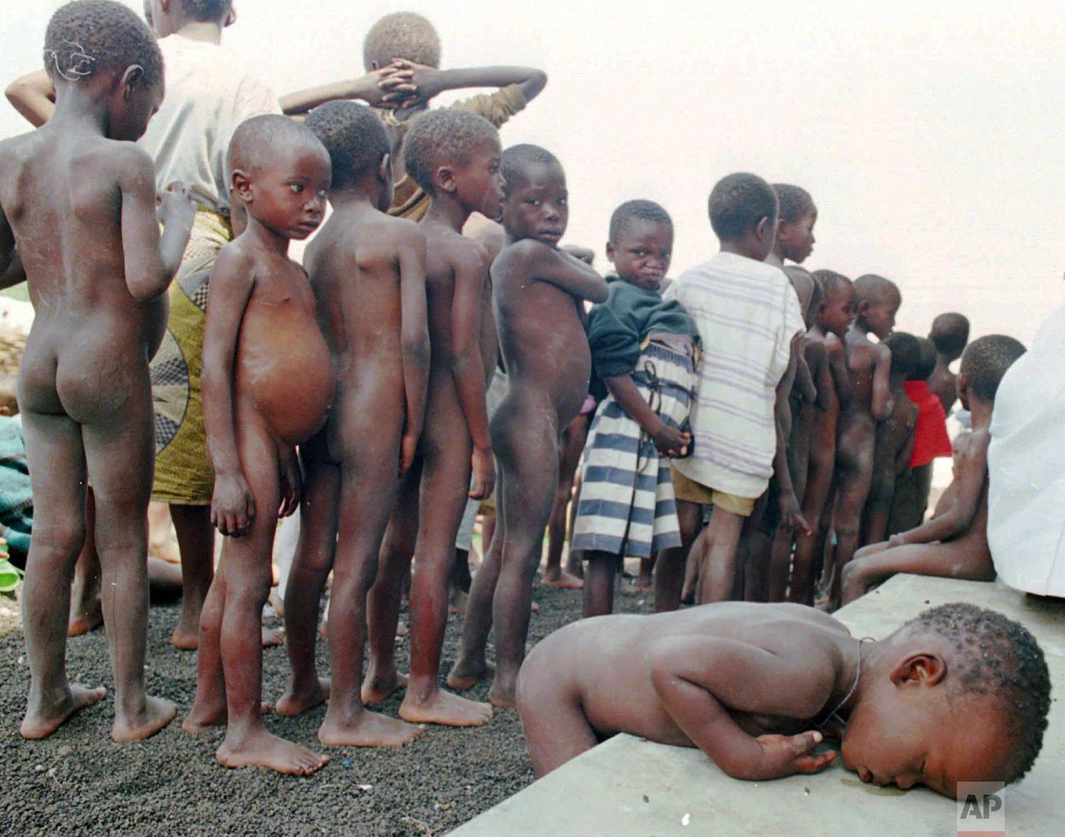A Rwandan child too weak to stand in line to receive a vaccination, rests his head at the SOS village orphanage in Ndosho near Goma, in Zaire, now known as Congo, July 28, 1994. (AP Photo/Jacqueline Arzt Larma)