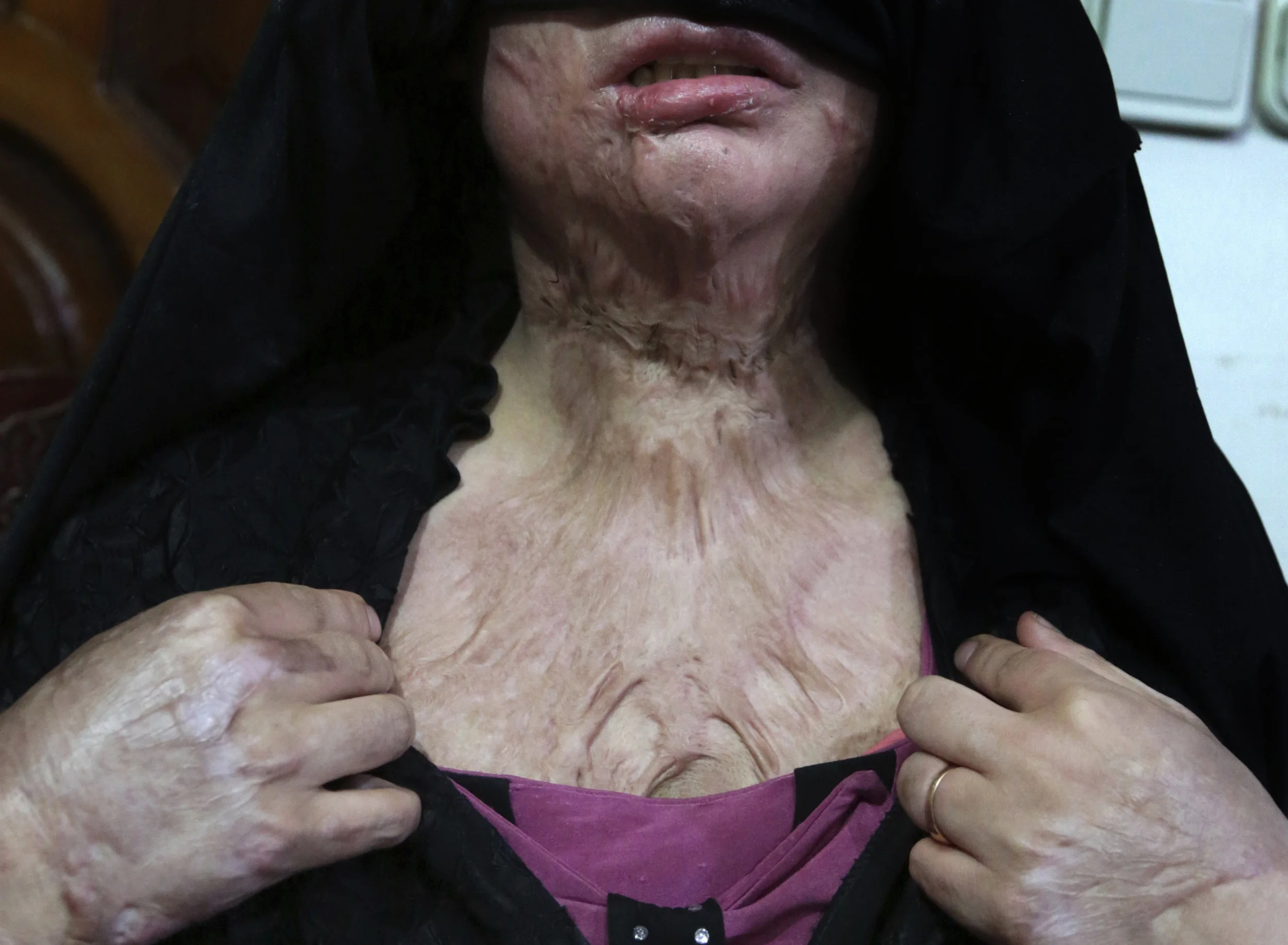 Khadeja, 18, who was burned by a pot of scalding hot water thrown by her husband, shows her wounds, at a women's shelter office in Herat, Afghanistan on Monday, Feb. 18, 2019. (AP Photo/Rahmat Gul)