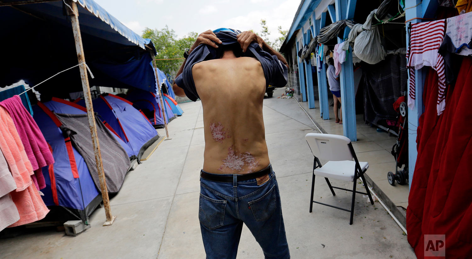 Jose Alfredo Diaz Reyes, 60, of Honduras, shows scarring on his lower back that he says is from an attack by suspected gang members in his native country while waiting at the Senda de Vida shelter in Reynosa, Mexico, May 1, 2019. (AP Photo/Eric Gay)