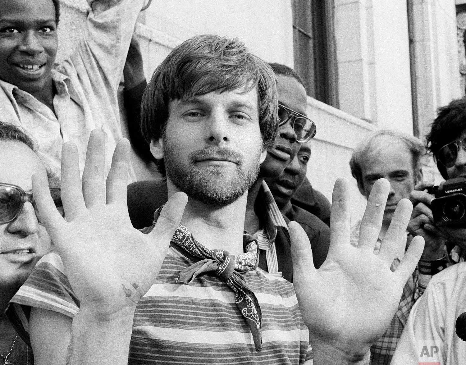 George Willig displays blistered hands after climbing to the top of the south tower of the World Trade Center in New York, May 26, 1977. Willig used a modified climbing rig to pull himself up the sheer side of the building hand over hand. (AP Photo/Dan Grossi)