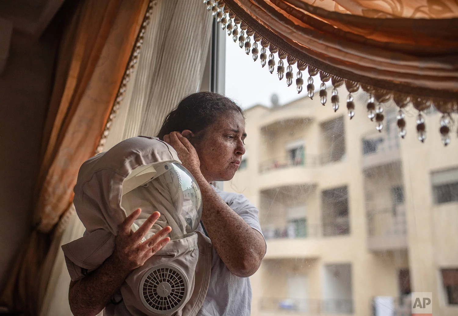Fatimazehra El Ghazaoui, 27, a woman affected by a rare disorder called xeroderma pigmentosum, or XP, poses for a portrait inside her home in Mohammedia, near Casablanca, Morocco, July 24, 2019. (AP Photo/Mosa'ab Elshamy)