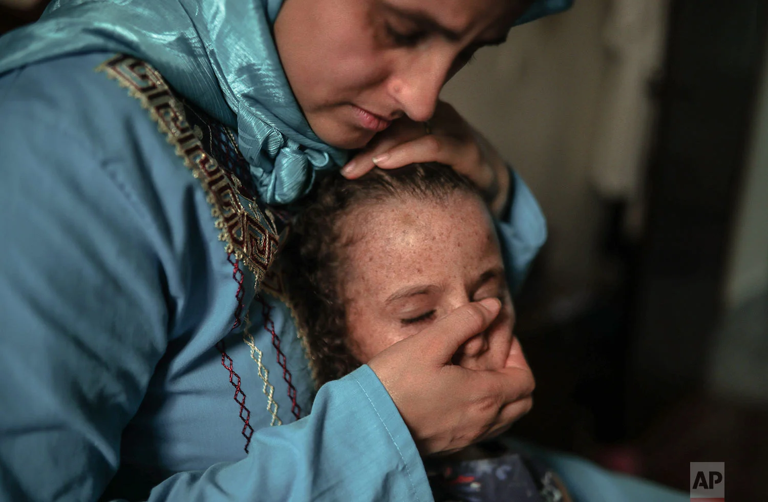 Maria El Maroufi, holds her 6 year old daughter Romaisae who is affected by a rare disorder called xeroderma pigmentosum, or XP, in their home in the town of Sale, near Rabat, Morocco, July 23, 2019. (AP Photo/Mosa'ab Elshamy)