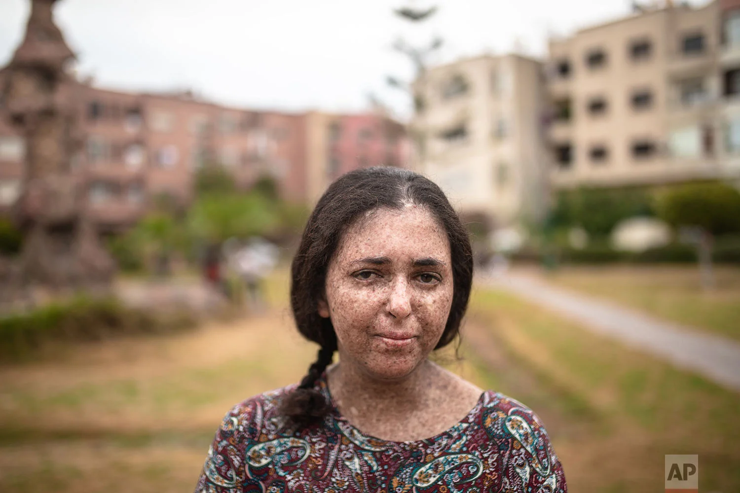 Fatimazehra El Ghazaoui, 27, a woman affected by a rare disorder called xeroderma pigmentosum, or XP, poses for a portrait inside her home in Mohammedia, near Casablanca, Morocco, July 16, 2019. (AP Photo/Mosa'ab Elshamy)