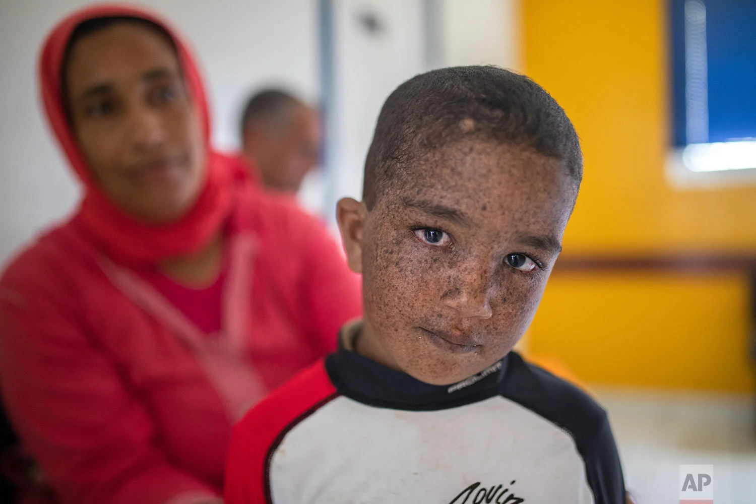 Mohammad, 6, who is affected by a rare disorder called xeroderma pigmentosum, or XP, waits with his mother inside a hospital in Casablanca, Morocco, July 24, 2019. (AP Photo/Mosa'ab Elshamy)