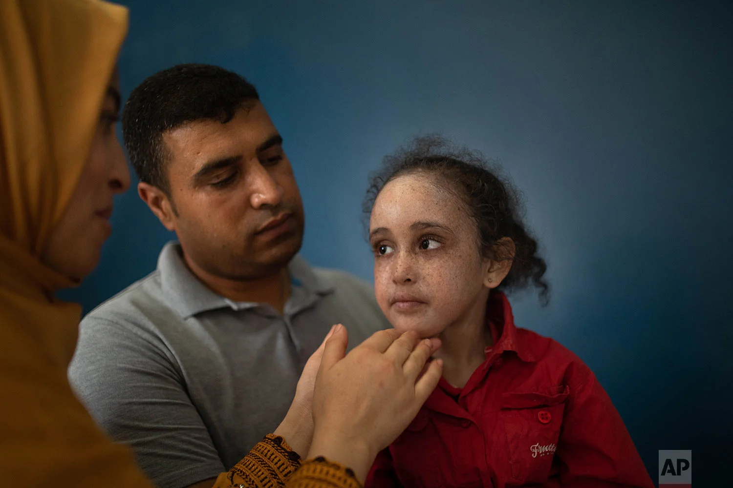 Rabiaa Waraqa, left, and Salaheddine Elkalshi, center, apply a cream to their 6 year old daughter Yasmin, who is affected by a rare disorder called xeroderma pigmentosum, or XP, in Casablanca, Morocco, July 24, 2019. (AP Photo/Mosa'ab Elshamy)