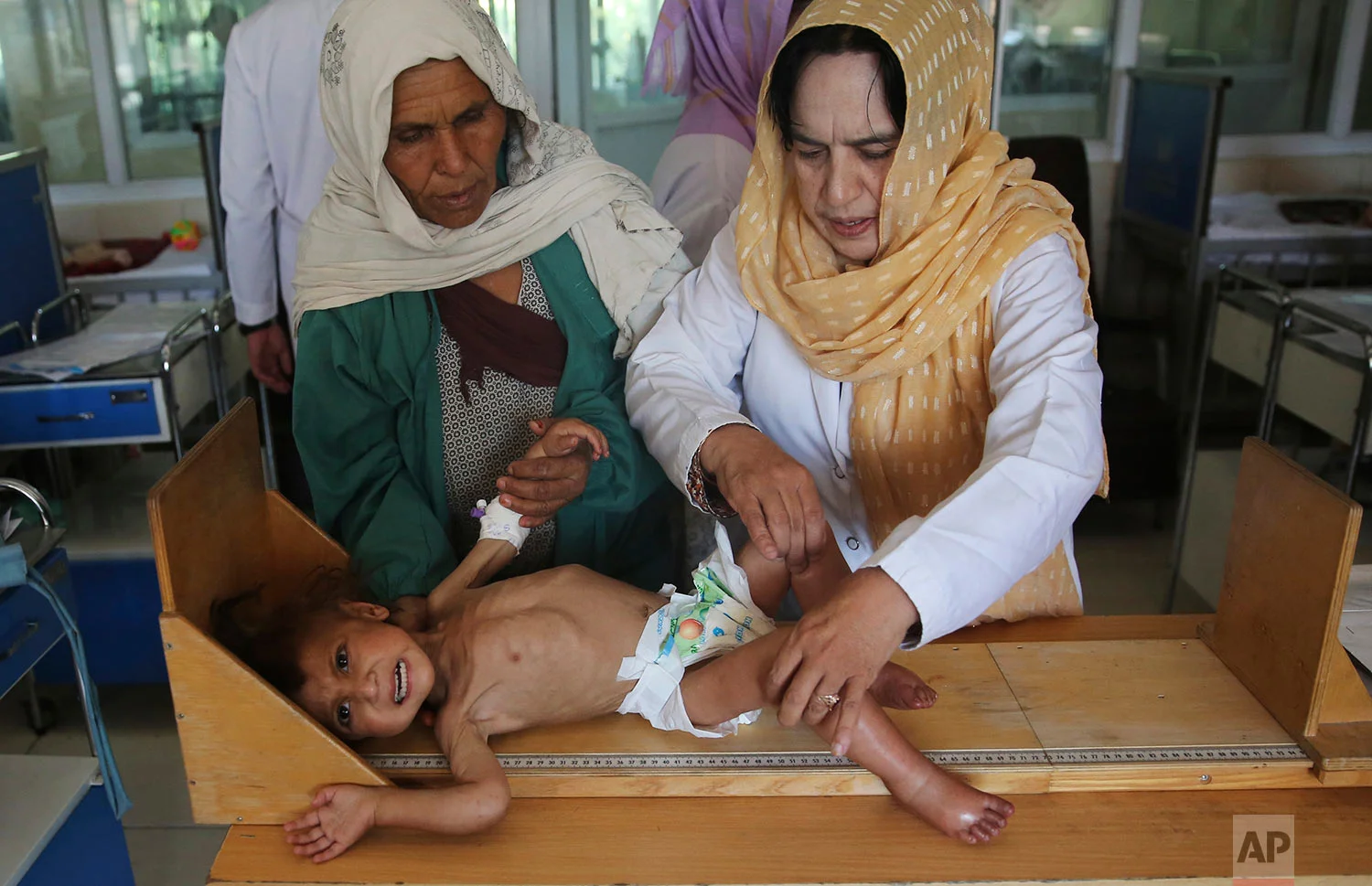 A nurse, right, checks the height of a malnourished girl, Humaira, in a ward at Indira Gandhi hospital in Kabul, Afghanistan, Aug. 21, 2019. (AP Photo/Rafiq Maqbool)