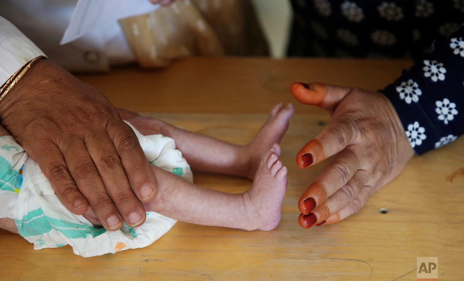 A nurse checks the feet of a malnourished baby in a ward at Indira Gandhi hospital in Kabul, Afghanistan, Aug. 21, 2019. (AP Photo/Rafiq Maqbool)