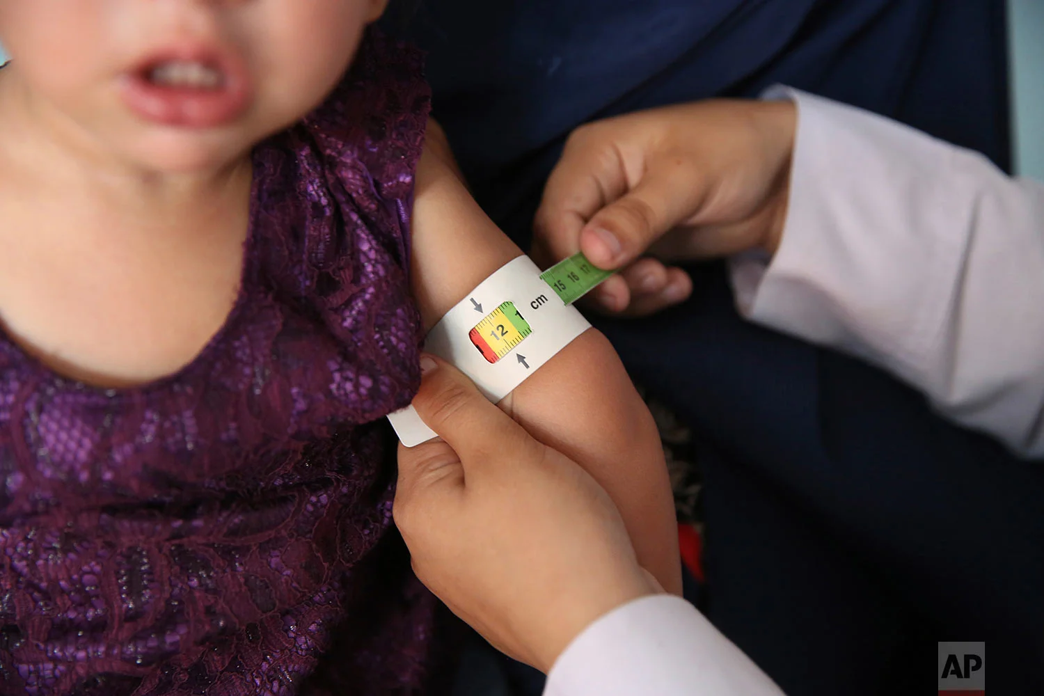 A doctor measures the arm of a malnourished girl at a UNICEF clinic in Jabal Saraj north of Kabul, Afghanistan, Aug. 26, 2019. (AP Photo/Rafiq Maqbool)