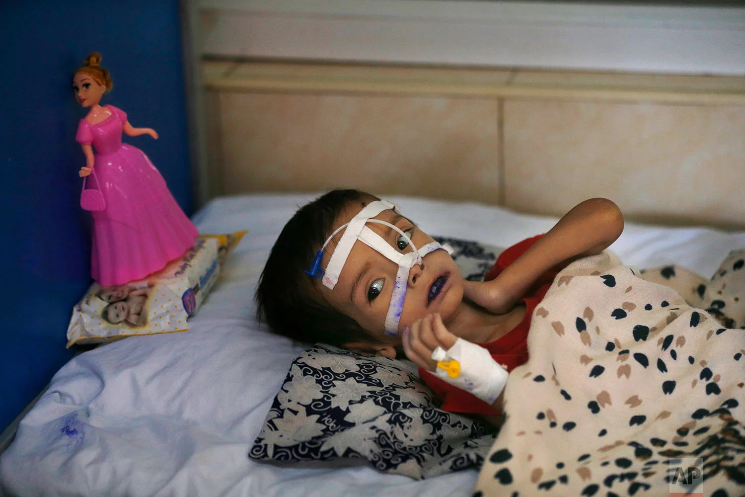 A malnourished girl lies on a bed in a ward at Indira Gandhi hospital in Kabul, Afghanistan, Aug. 21, 2019. (AP Photo/Rafiq Maqbool)