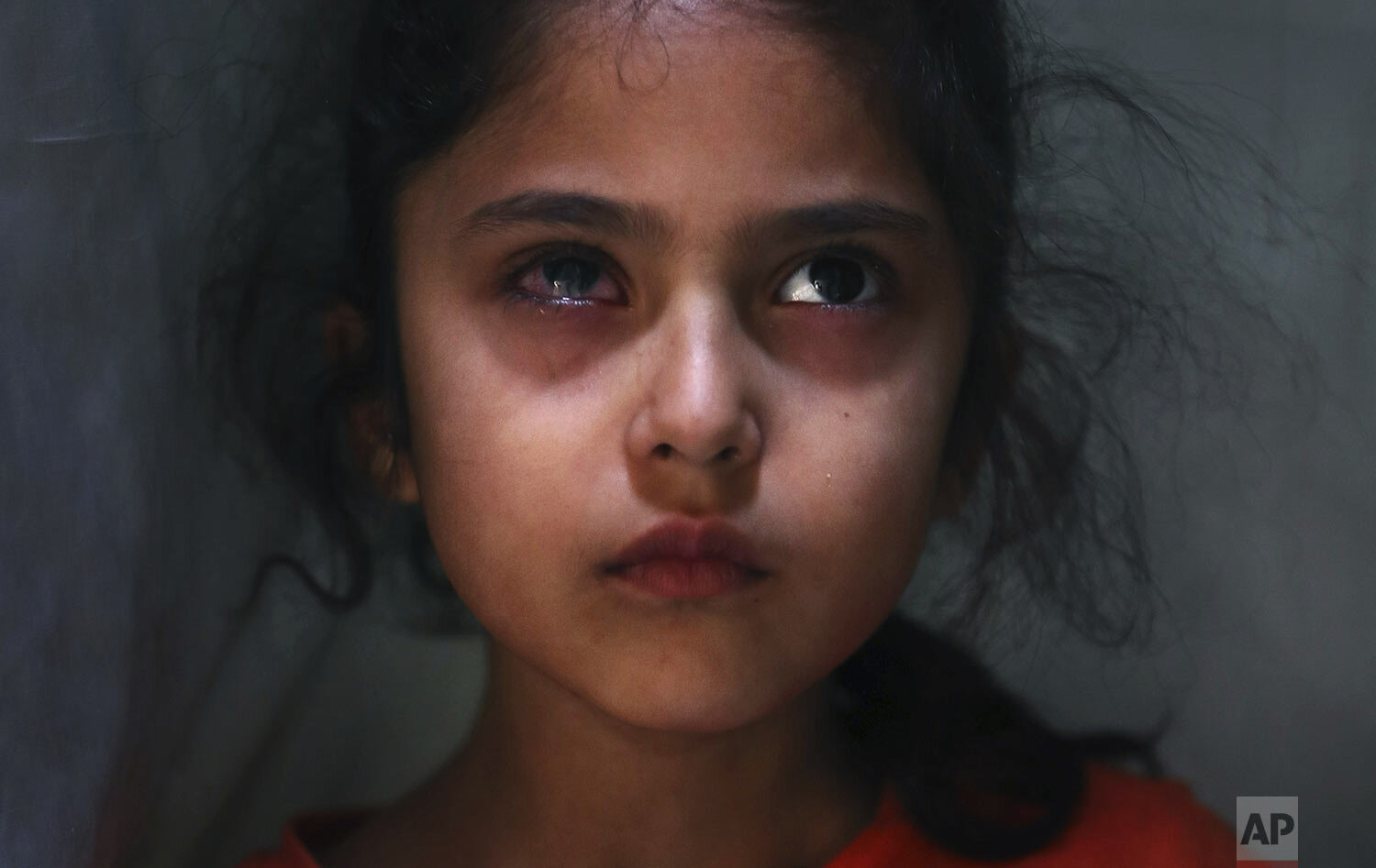 Muneefa Nazir, 6, a Kashmiri girl whose right eye was hit by a marble ball shot allegedly by Indian Paramilitary soldiers on Aug. 12, stands outside her home in Srinagar, Indian controlled Kashmir, Tuesday, Sept. 17, 2019. (AP Photo/Mukhtar Khan)