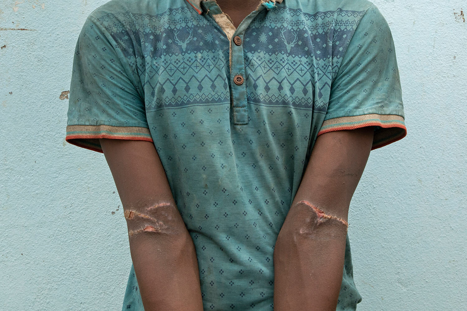 المهاجر من إهوبيان إبراهيم بكالة حسن ، 24 عاماً ، يظهر ندوباً من التعذيب في حوش في لحج ، اليمن.  يقول إن ذراعيه كانت مربوطة خلف ظهره ، ويريد العودة إلى إثيوبيا.  (AP Photo / ناريمان المفتي)