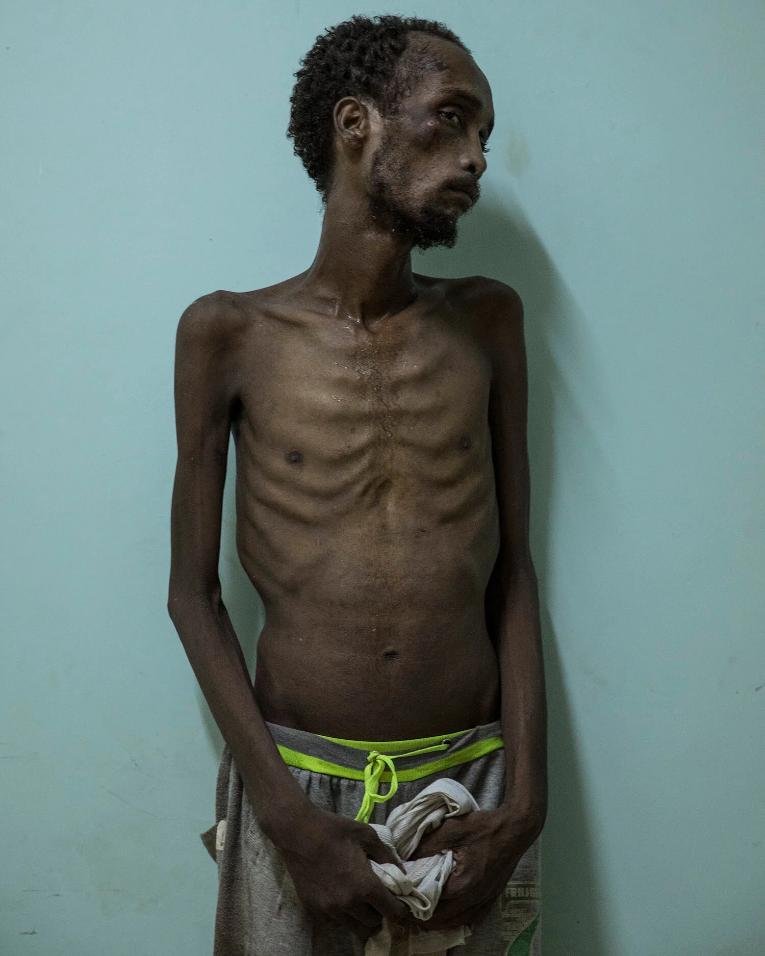 Ethiopian migrant Abdo Yassin, 23, of Oromo descent, stands for a photo at the Ras Alara Hospital, in Lahj, Yemen. Yassin says he was in a hosh locked up and tortured for months because he didn't have the money to pay a ransom. (AP Photo/Nariman El-Mofty)