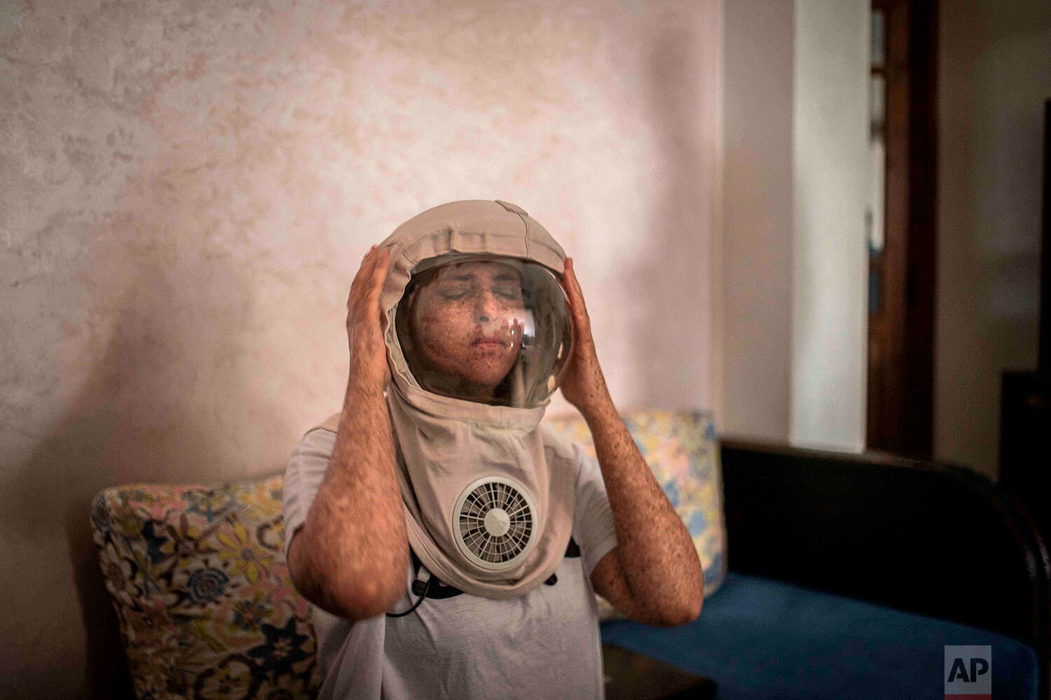  Fatimazehra El Ghazaoui, 27, a woman affected by a rare disorder called xeroderma pigmentosum, or XP, puts on a protective mask she wears outside on sunny days, in her home in Mohammedia, Morocco, near Casablanca, on July 16, 2019. (AP Photo/Mosa'ab