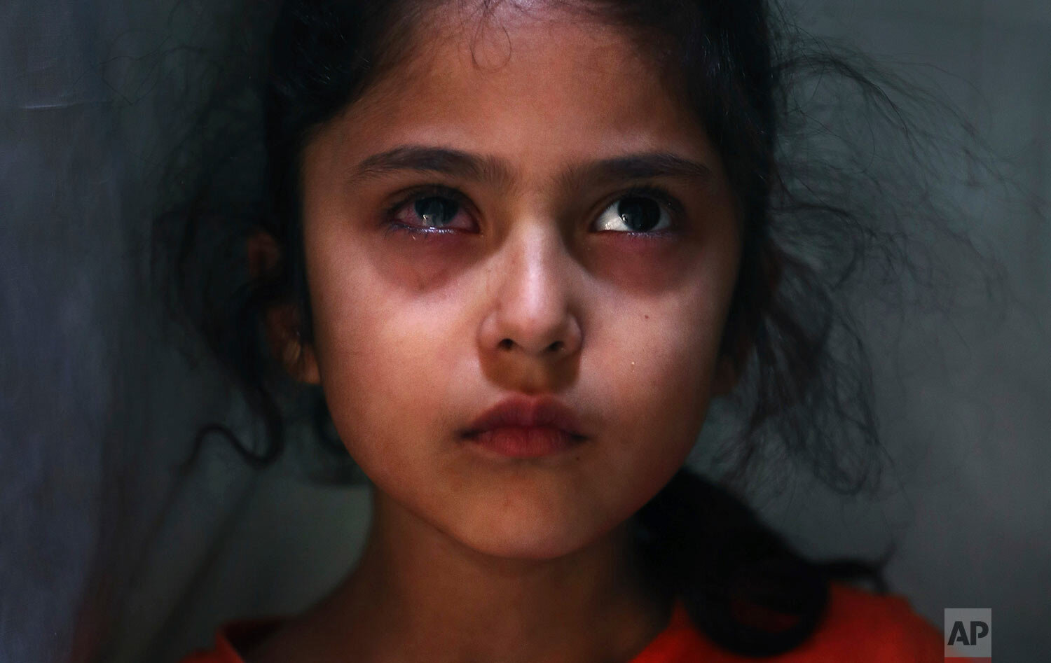  Six-year-old Muneefa Nazir, a Kashmiri girl whose right eye was hit by a marble ball shot allegedly by Indian Paramilitary soldiers on Aug. 12, stands outside her home in Srinagar, Indian controlled Kashmir on Sept. 17, 2019. (AP Photo/Mukhtar Khan)