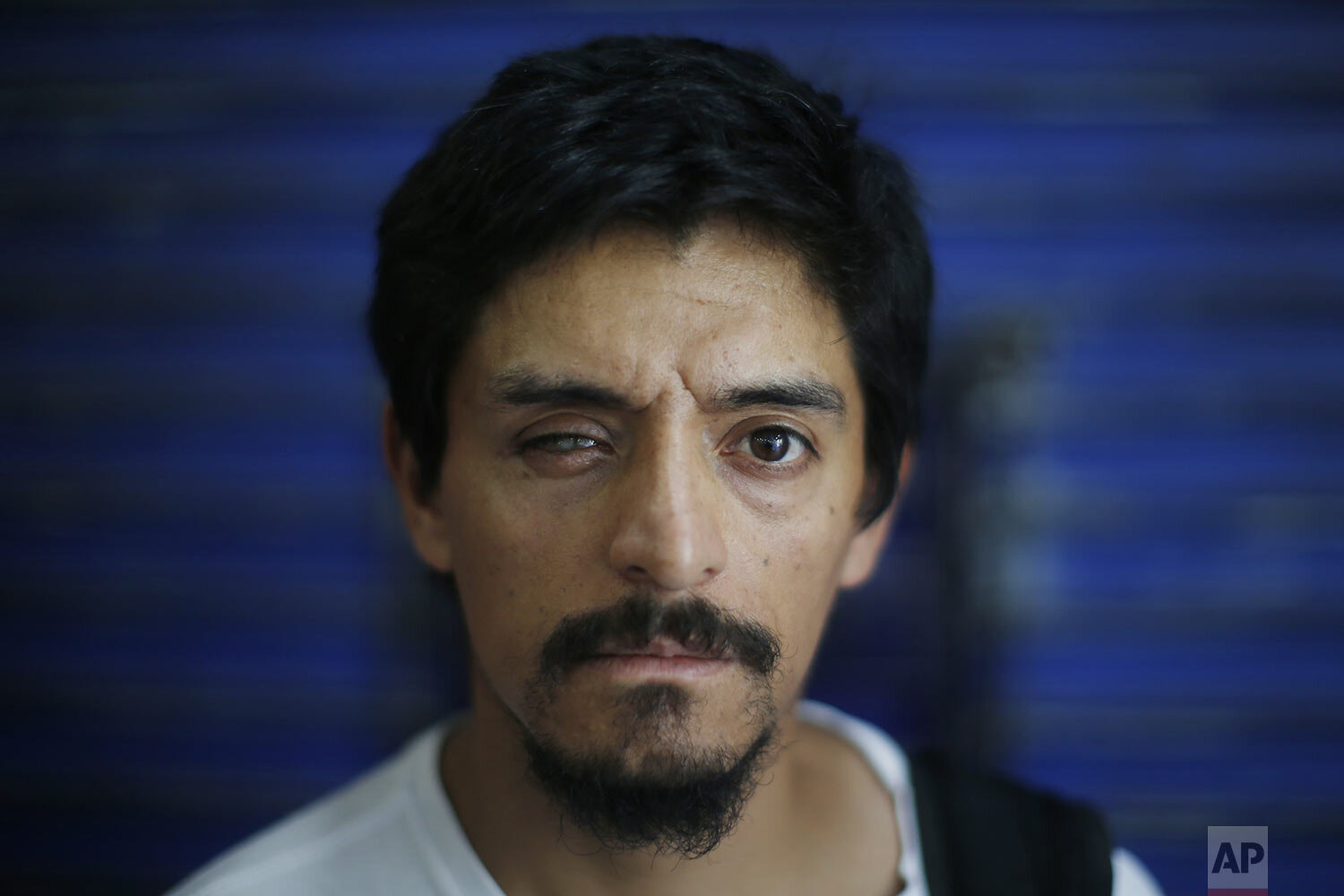  Eliacer Flores, who says his eye was injured when he was shot by police during an anti-government demonstration, poses for a portrait during a protest outside La Moneda presidential place in Santiago, Chile, Dec. 13, 2019. The U.N. released a report