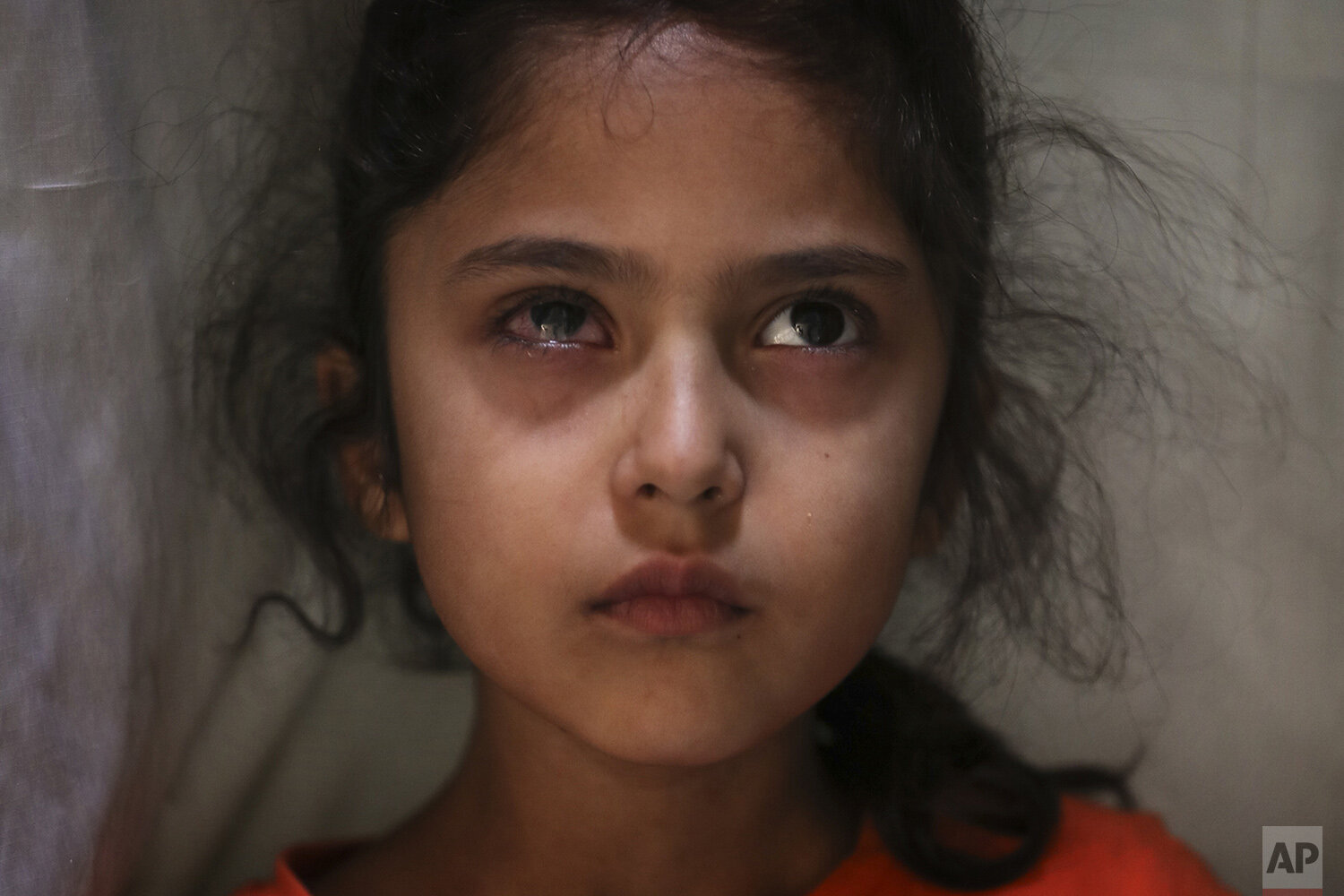  Six-year-old Muneefa Nazir, a Kashmiri girl whose right eye was hit by a marble ball shot allegedly by Indian Paramilitary soldiers on Aug. 12, stands outside her home in Srinagar, Indian controlled Kashmir, Sept. 17, 2019. (AP Photo/Mukhtar Khan) 