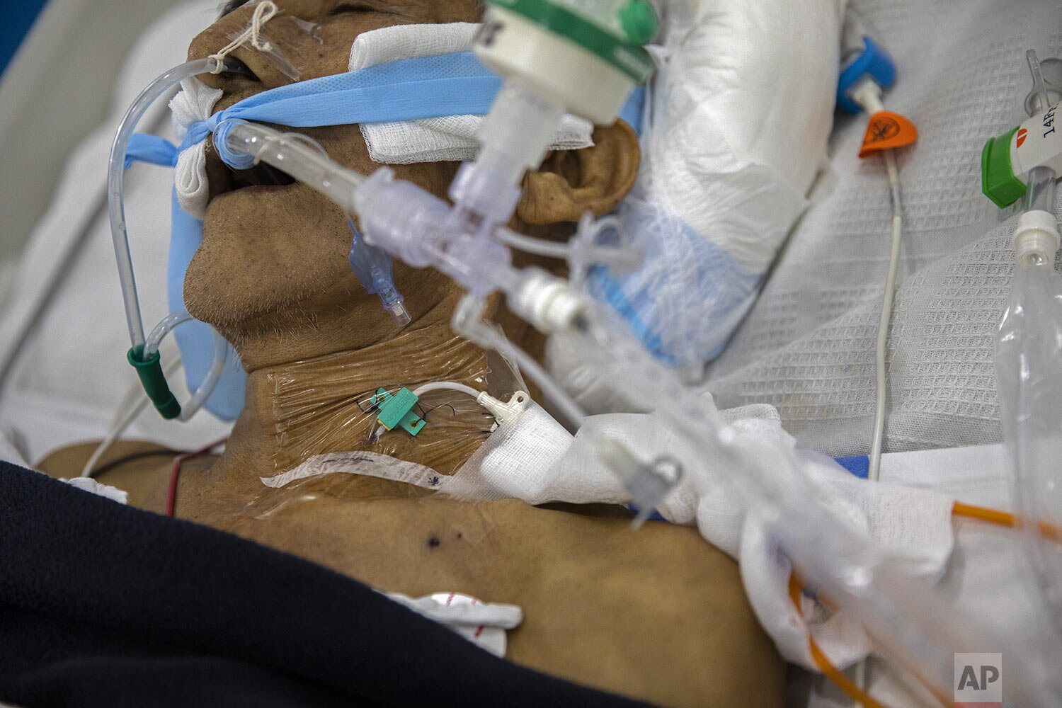  A COVID-19 patient is assisted by an artificial respirator in the intensive care area of a public hospital in Pucallpa, in Peru’s Ucayali region, Tuesday, Oct. 6, 2020. (AP Photo/Rodrigo Abd) 